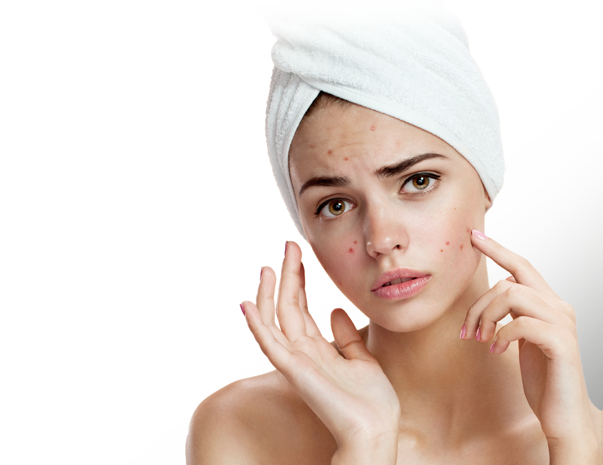 https://amchealth.net/wp-content/uploads/2023/04/acne-scars-treatment-4.png