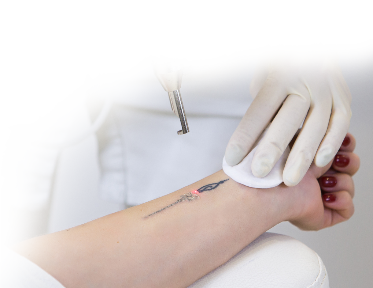 https://amchealth.net/wp-content/uploads/2023/04/tattoo-removal-2.png