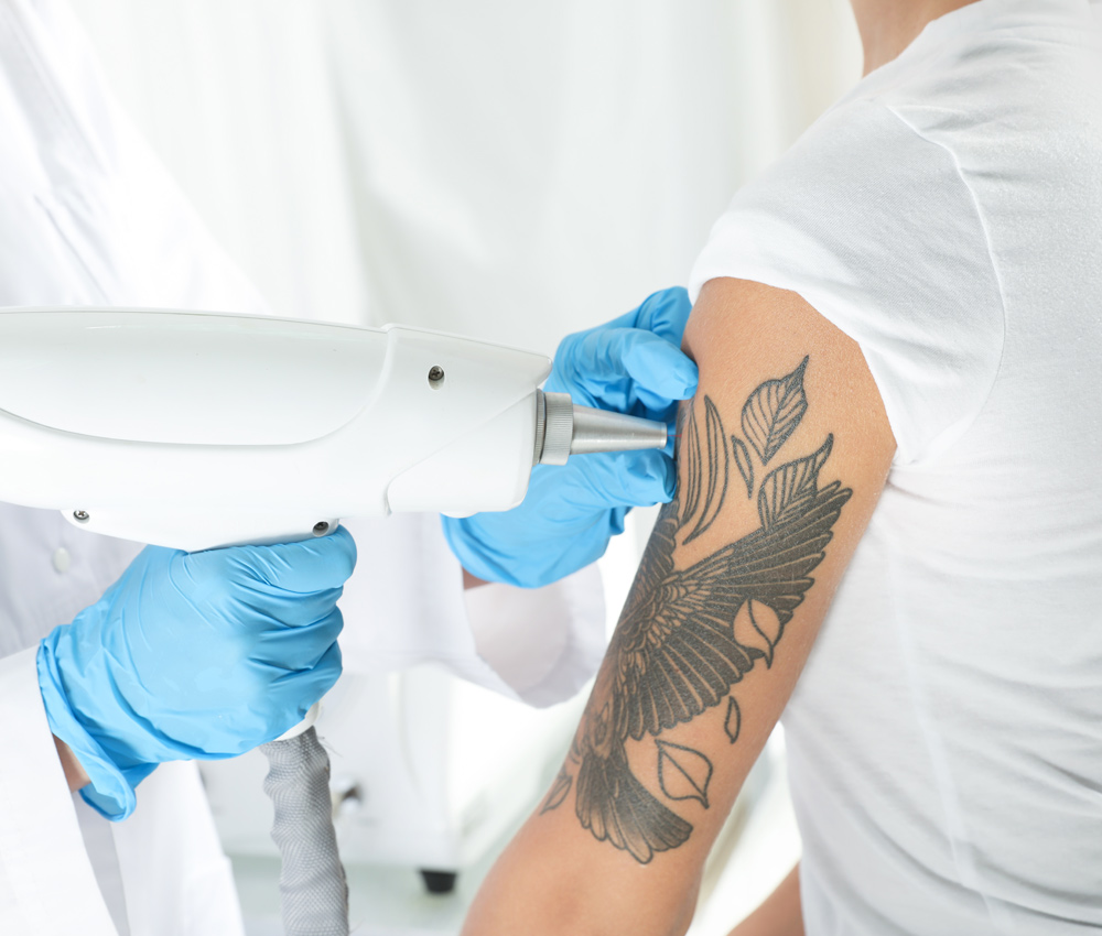 https://amchealth.net/wp-content/uploads/2023/04/tattoo-removal-a.jpg